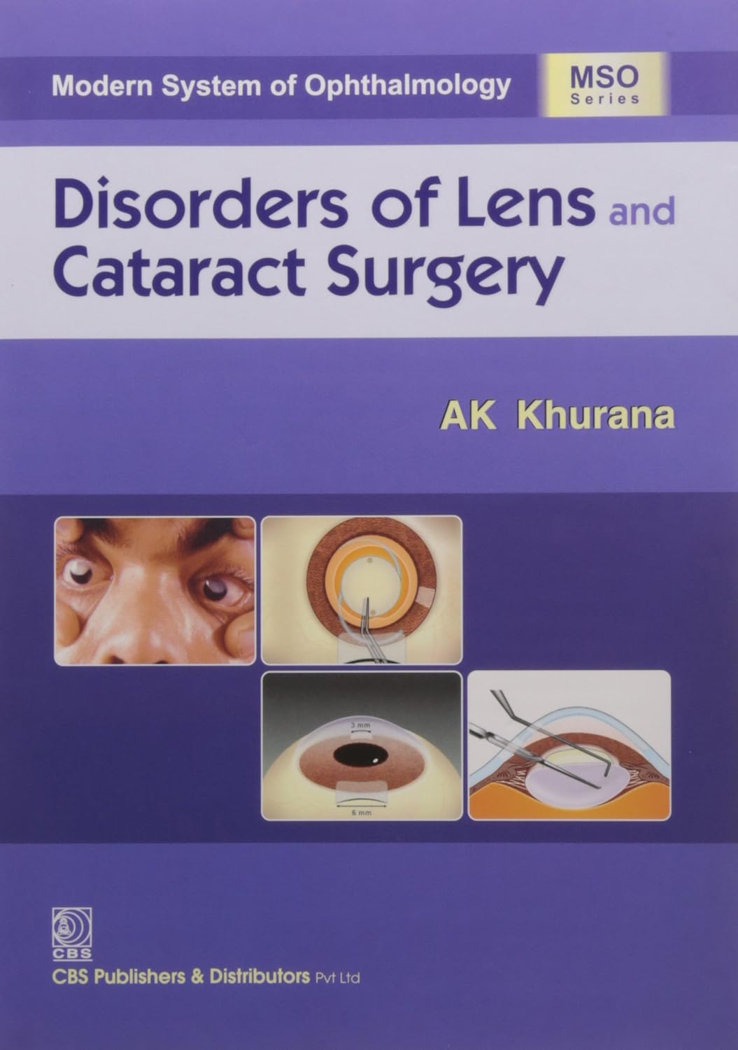 Disorders Of Lens An Cataract Surgery ( Pb-2014) (Modern System of Ophthalmology (MSO) Series)